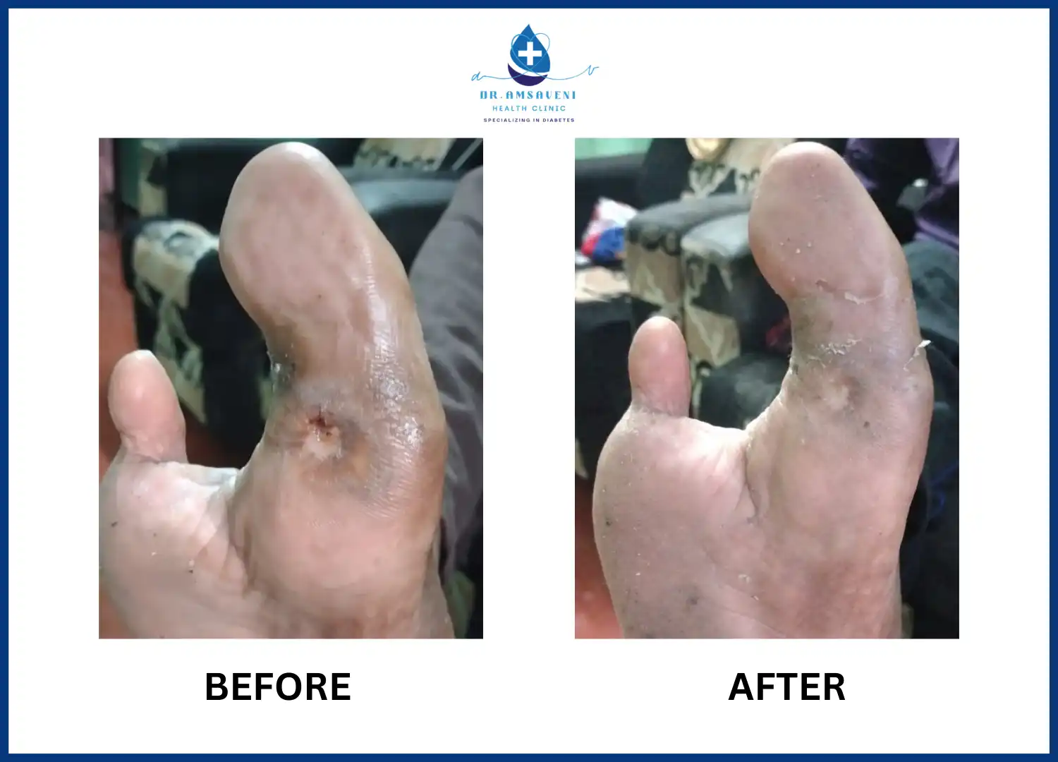 Diabetic Foot Ulcer Stages