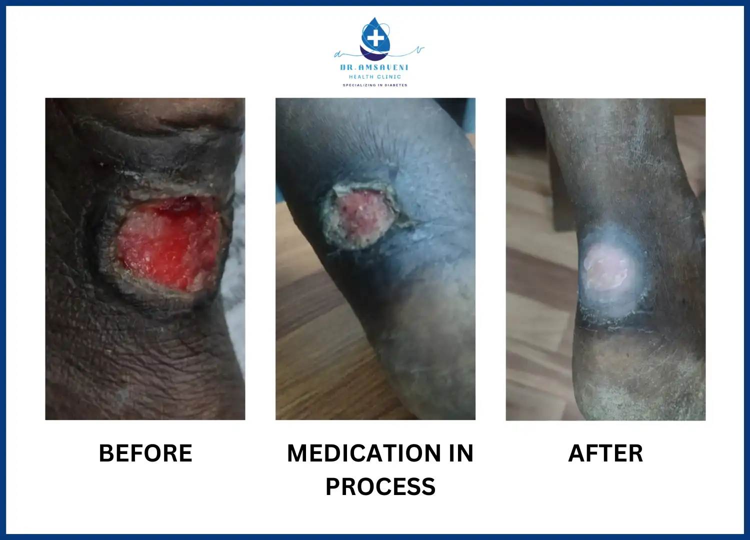 Diabetic Foot Ulcer Treatment and Recovery