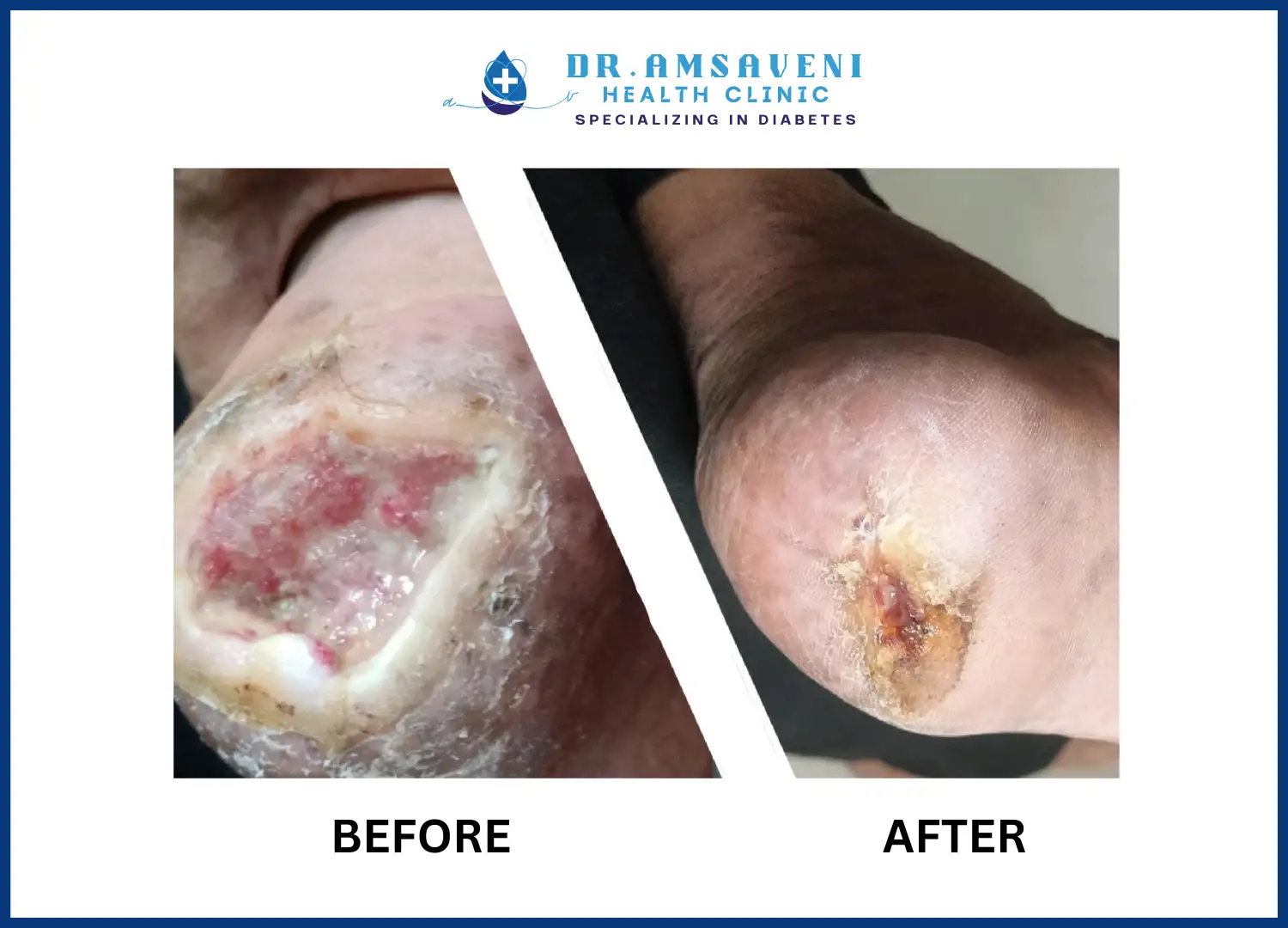 Successful Treatment for Diabetic Foot Ulcer