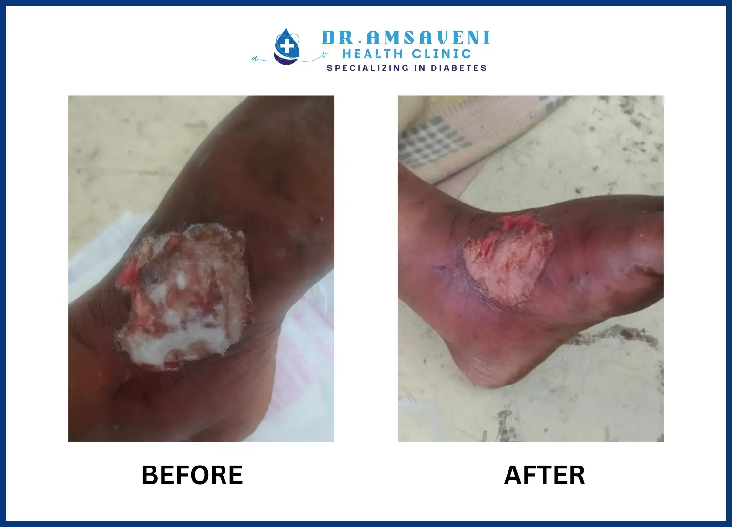 Treatment for Diabetic Foot Ulcer